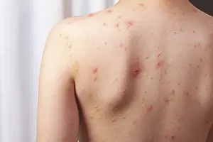 Medical Examination Process Drucke: A child stands with their back facing the camera