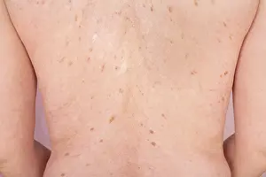 Skin Cancer Prevention Drucke: Close-up of a human back with spots