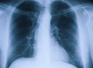 Medical Diagnosis Drucke: Frontal X-ray of two lungs