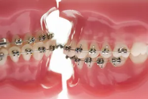 Dental Models Drucke: Two models of teeth facing each other in a dentist's office