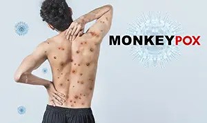 Healthcare System Protection Drucke: People with monkeypox on isolated background