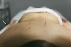 Chinese Medicine Therapy Drucke: Acupuncture process client