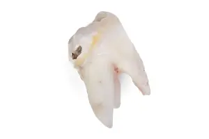 Bright Light Photography Drucke: Pulled wisdom tooth, tooth, carious