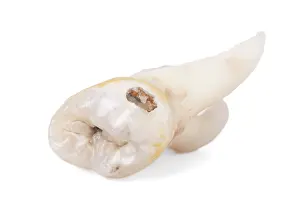 Pulled Wisdom Tooth Drucke: Pulled wisdom tooth, tooth, carious