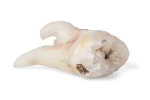 Pulled Wisdom Tooth Drucke: Pulled wisdom tooth, tooth, carious