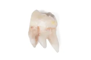 Bright Light Photography Drucke: Pulled wisdom tooth, tooth, carious