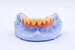 Dentist Treatment Drucke: Removable denture of an upper jaw
