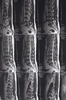 Magnetic Resonance Imaging (MRI) Drucke: Slipped disc