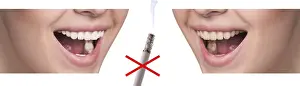 Healthy Smile Drucke: Smile before and after smoking