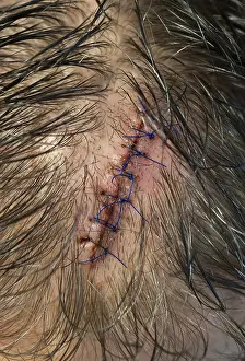 Close Up View Drucke: A stitched wound on the man's head