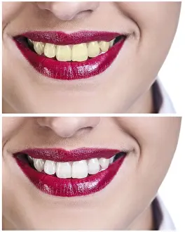 Dental Care Concept Drucke: Teeth before and after bleaching treatment