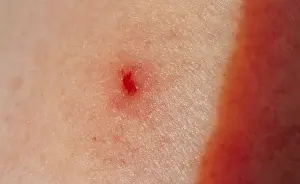 Freshwater Fish Habitat Drucke: Tick bite