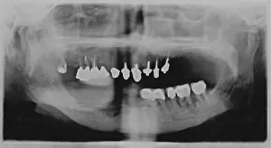 X Ray Photographs Drucke: Tooth x-ray