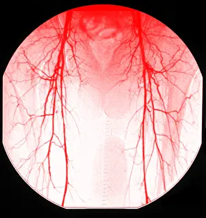Circulatory System Drucke: Aortic Angiogram