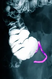 Human Anatomy Images Drucke: Appendix x-ray with barium contrast