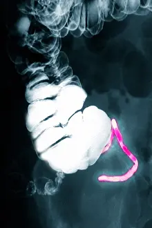 Medical X Ray Images Drucke: Appendix x-ray with barium contrast