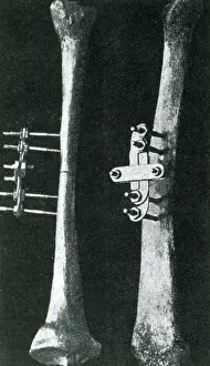 Medical History Drucke: Bone Clamp