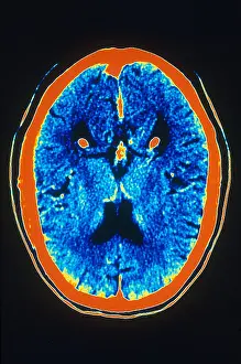 Human Brain Anatomy Drucke: Brain, CT Scan