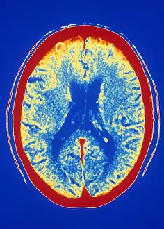 Computed Tomography Scans Drucke: Brain, CT Scan
