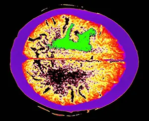 Computed Tomography Scans Drucke: Brain edema