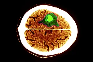 Gerahmter Druck : Hirnödem. Farbförderter CT-Scan des Gehirns, der Ödem Gerahmter Druck : Hirnödem. Farbförderter CT-Scan des Gehirns, der Ödem
