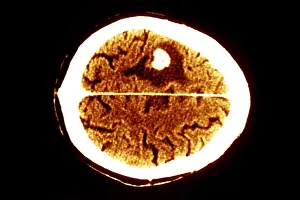 Computed Tomography Scans Drucke: Brain edema