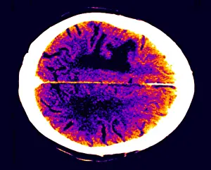 Computed Tomography Scans Drucke: Brain edema