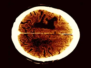 Computed Tomography Scans Drucke: Brain edema