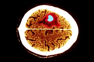 Brain edema