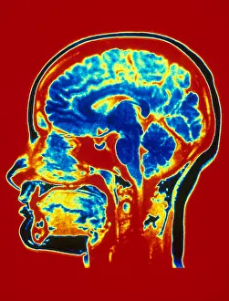 Brain MRI Scan Drucke: Brain MRI