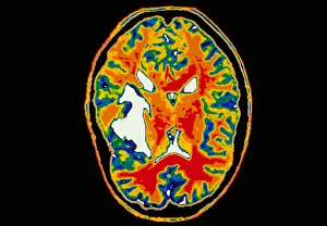 Magnetic Resonance Imaging MRI Drucke: Brain tumor