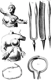 Medical Instrument History Drucke: Breast Surgery Instruments, 1772