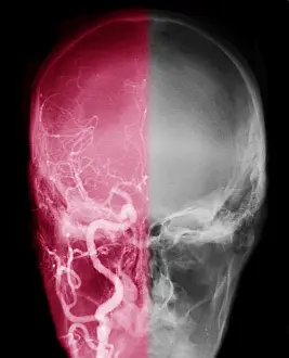Zerebrales Angiogramm