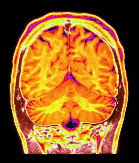 Brain MRI Scan Drucke: Cerebral MRI