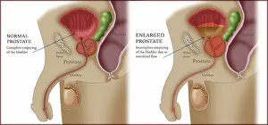 Male Reproductive System Drucke: Comparison of Normal and Enlarged Prostate