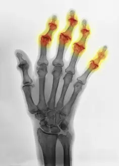 Degenerative Arthrose