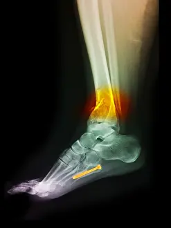 Medical Imaging Techniques Drucke: Fractured Ankle