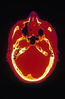 Computed Tomography Scans Drucke: Head, CT Scan