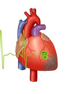 Medical Anatomy Drawing Drucke: Heart Attack