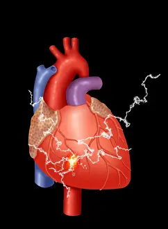 Gerahmter Druck : Herzinfarkt Gerahmter Druck : Herzinfarkt