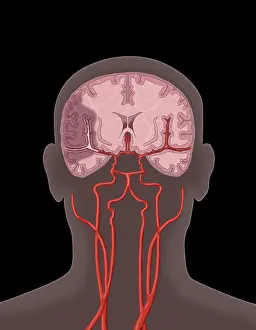 Medical Science Illustrations Drucke: Ischemic Stroke, Illustration