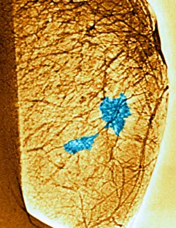 Medical Imaging Techniques Drucke: Mammogram