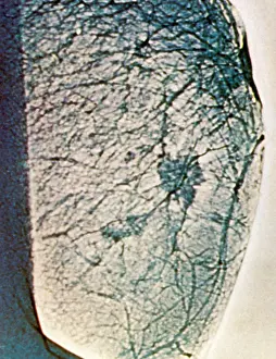 Mammogram