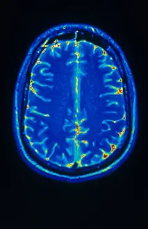 Normal Brain Structure Drucke: MRI of Brain