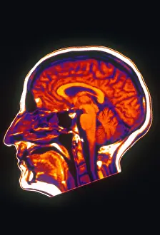 Normal Brain Anatomy Drucke: MRI of Brain