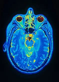 Normal Brain Structure Drucke: MRI of Brain