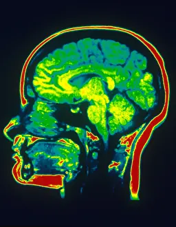 Normal Brain Anatomy Drucke: MRI of Brain
