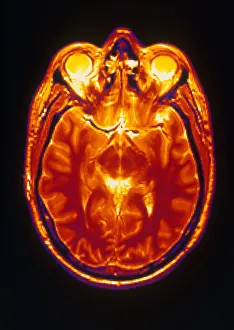 Normal Brain Structure Drucke: MRI of Brain