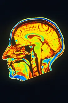 Normal Brain Anatomy Drucke: MRI of Brain