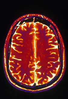 Normal Brain Structure Drucke: MRI of Brain
